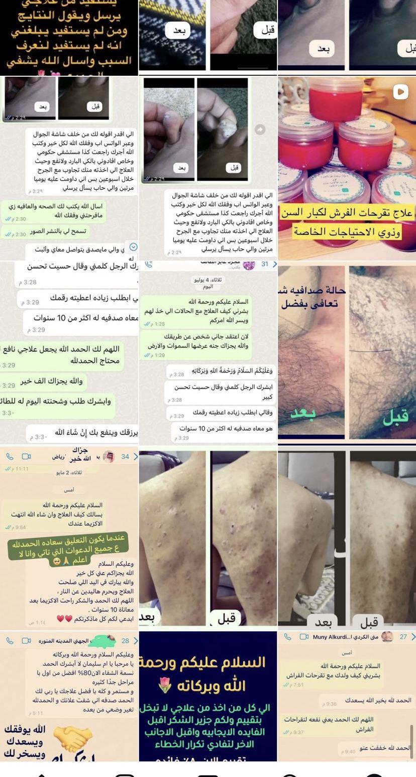 للاكزيما والصدافيه